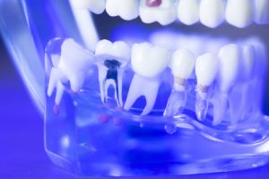 The Cost Of Wisdom Teeth Removal In Perth