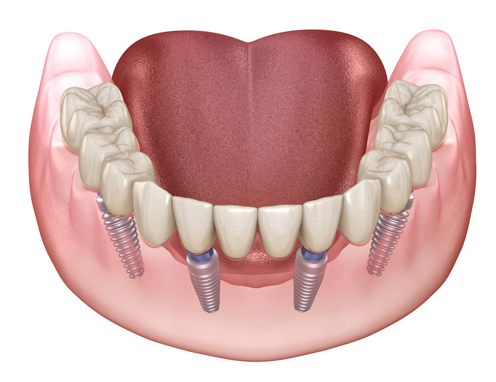 6 Benefits Of All On 4 Implants in Ellenbrook That You Need To Know